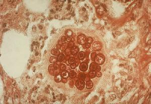 The image of coccidioidomycosis spherule.